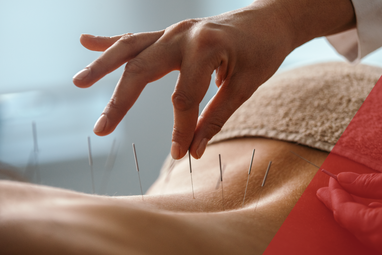 Acupuncture Open House